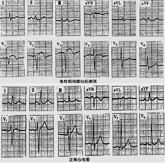 心梗心電圖