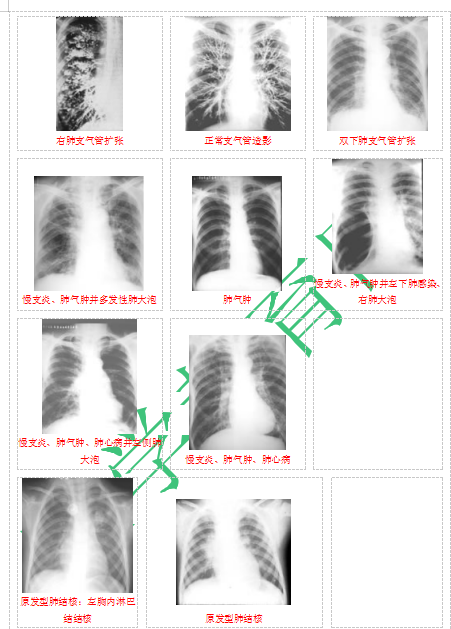 快收藏！臨床助理醫(yī)師實(shí)踐技能62個(gè)胸片（圖片診斷）