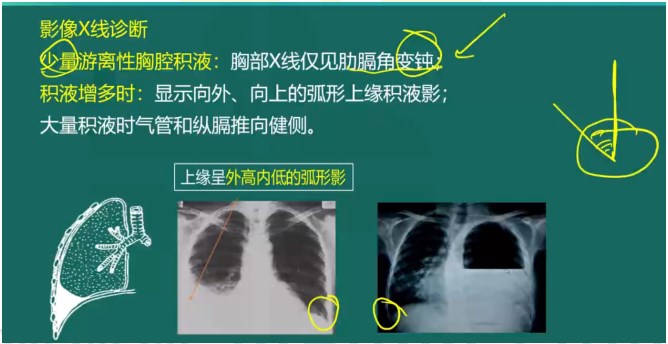 胸腔積液影像X線診斷